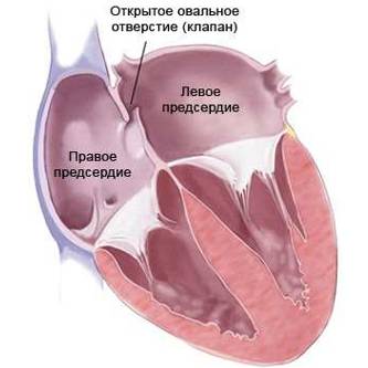 Открытый артериальный (Боталлов) проток